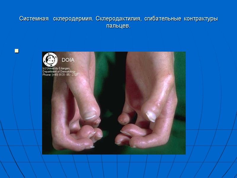 Системная  склеродермия. Склеродактилия, сгибательные контрактуры пальцев.